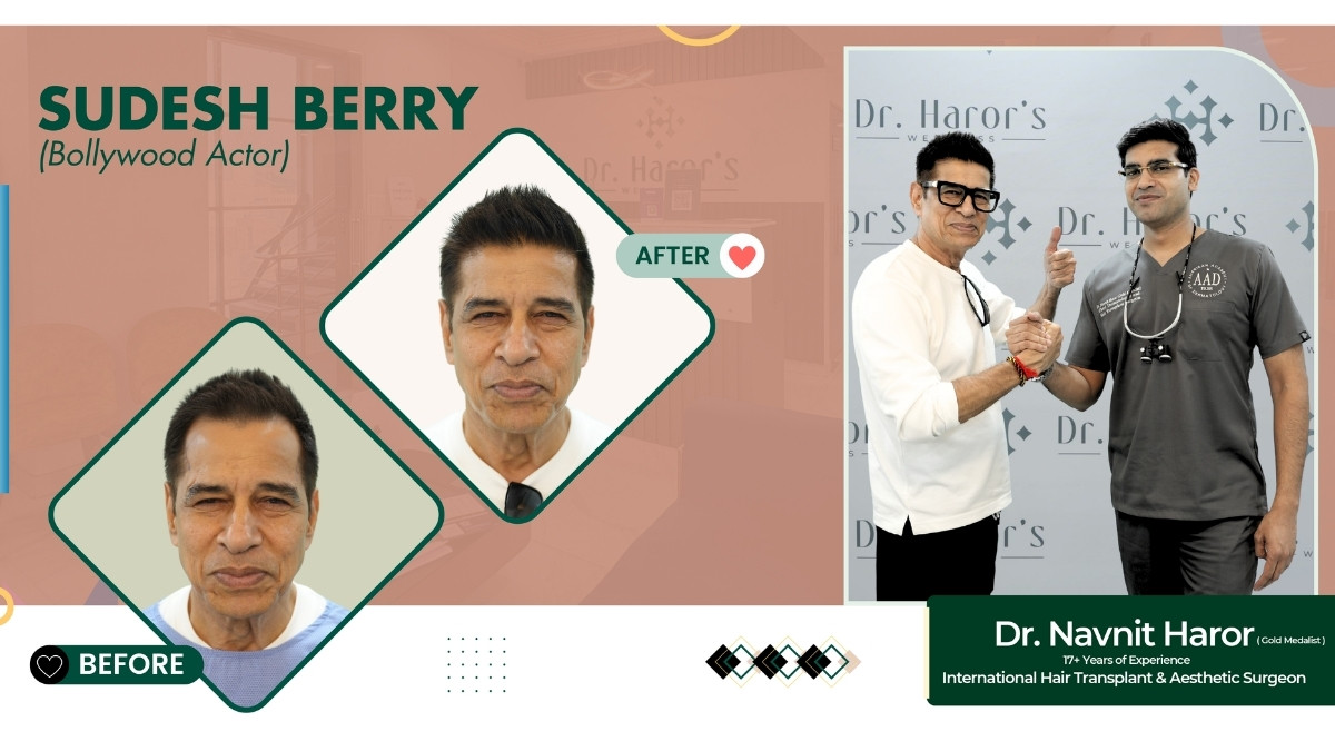 Celebrity Hair Transplant: You’d Never Guess They Had a Hair Transplant—But They Did!-PNN